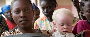 Bahia vai implantar linha de cuidado  sade integral das pessoas com albinismo